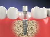 Easy Dental Implants: Your Guide To A Beautiful Smile